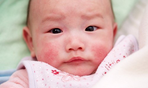 Thanh Mộc Hương điều trị chàm sữa an toàn cho bé bằng thảo dược