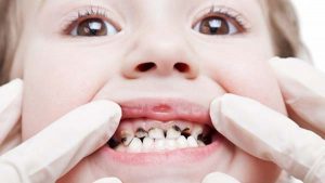 Cách phòng và chữa bệnh sâu răng hiệu quả tại nhà