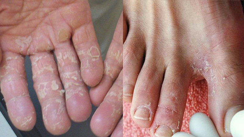 Nước ăn chân tay là gì? Thuốc trị nước ăn chân tay hiệu quả và an toàn